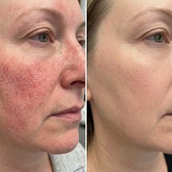 Лечение купероза и сосудистых звёздочек IPL на аппарате Venus Versa в Perfect Clinic СПб