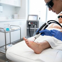 Лазерная эпиляция стоп диодным лазером WingDerm в Perfect Clinic СПб