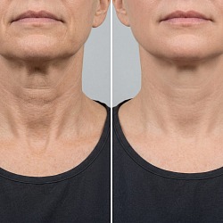 Ботокс для шеи в СПб — коррекция колец Венеры в Perfect Clinic