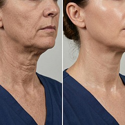 Биоревитализация шеи и декольте в СПб — процедура Perfect Clinic