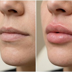 Увеличение губ филлером в клинике Perfect Clinic СПб — результат до и после