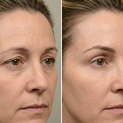 Лифтинг бровей ботоксом в СПб — chemical brow lift без операции в Perfect Clinic