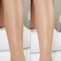 Диодный лазер WingDerm подходит для всех фототипов кожи